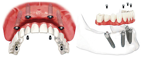 种植牙示意图片 种植牙示意图片