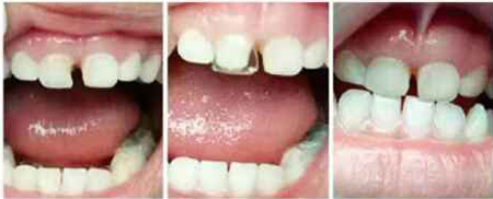 补牙前后对比图 补牙前后对比图