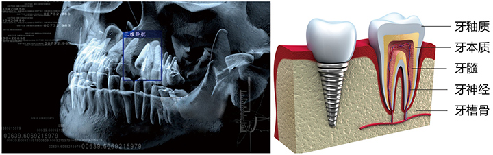 种植牙示意图 种植牙示意图