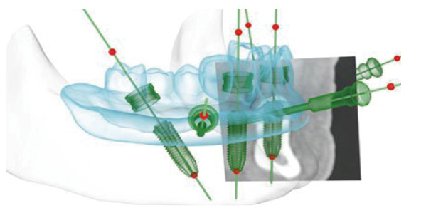 美奥口腔显微种植牙图片 美奥口腔显微种植牙图片