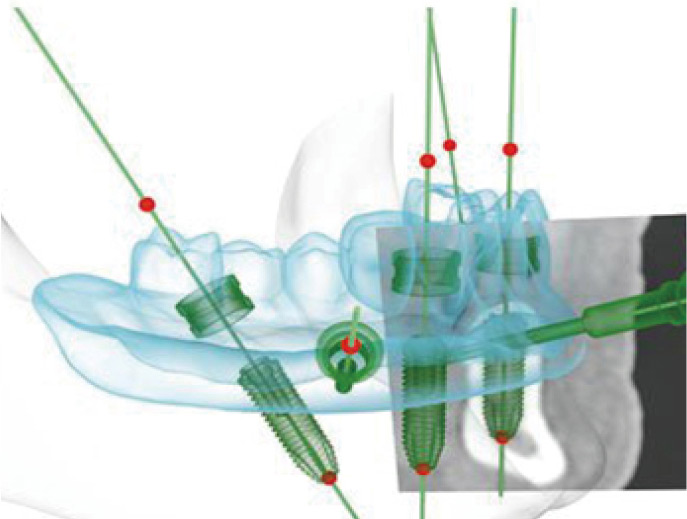 美奥口腔三维种植导板 美奥口腔三维种植导板