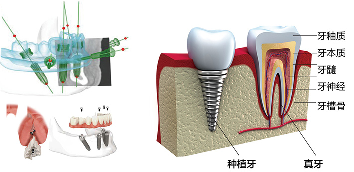 美奥种植牙 美奥种植牙