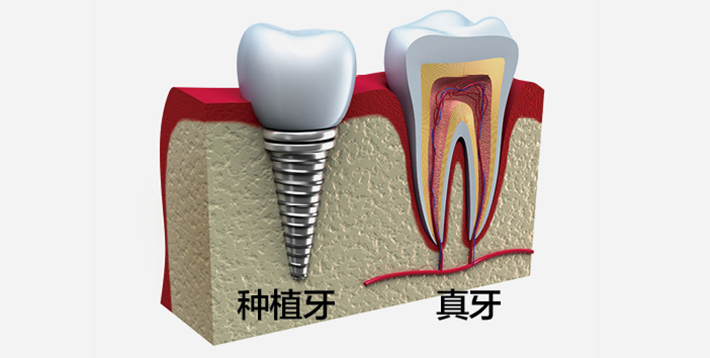 种植牙与真牙对比 种植牙与真牙对比